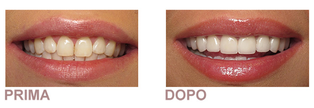 faccette-dentali