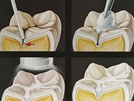 sigillature denti